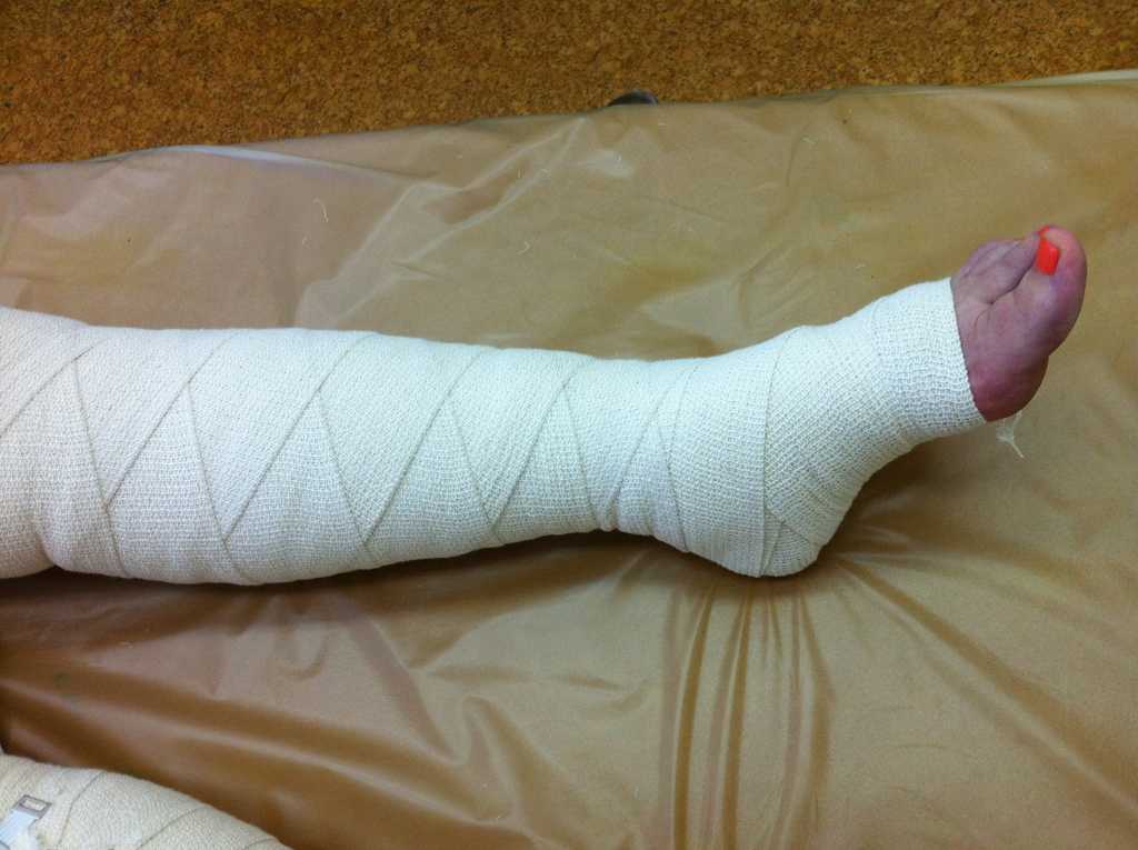 Бинтование ноги после операции. Перевязка ноги эластичным бинтом.